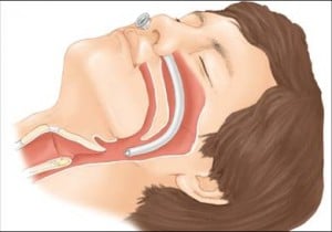 Airway