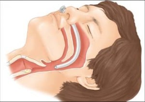 Airway