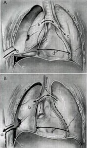 Sucking_chest_wound_mechanics