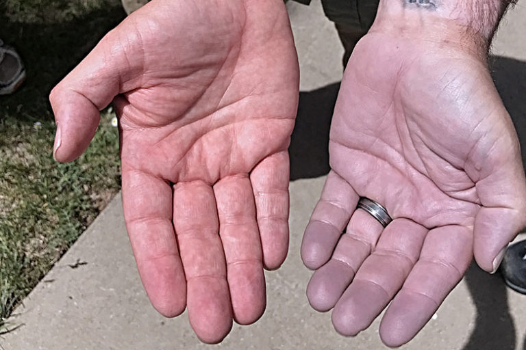 Backcountry Emergencies Managing Sprains, Strains and Breaks ITS