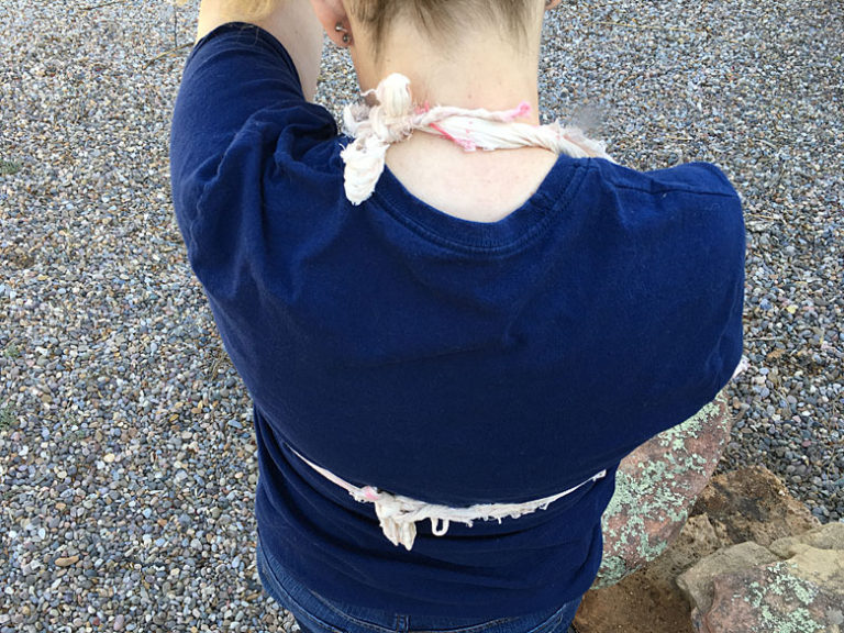 Backcountry Emergencies Managing Sprains, Strains and Breaks ITS